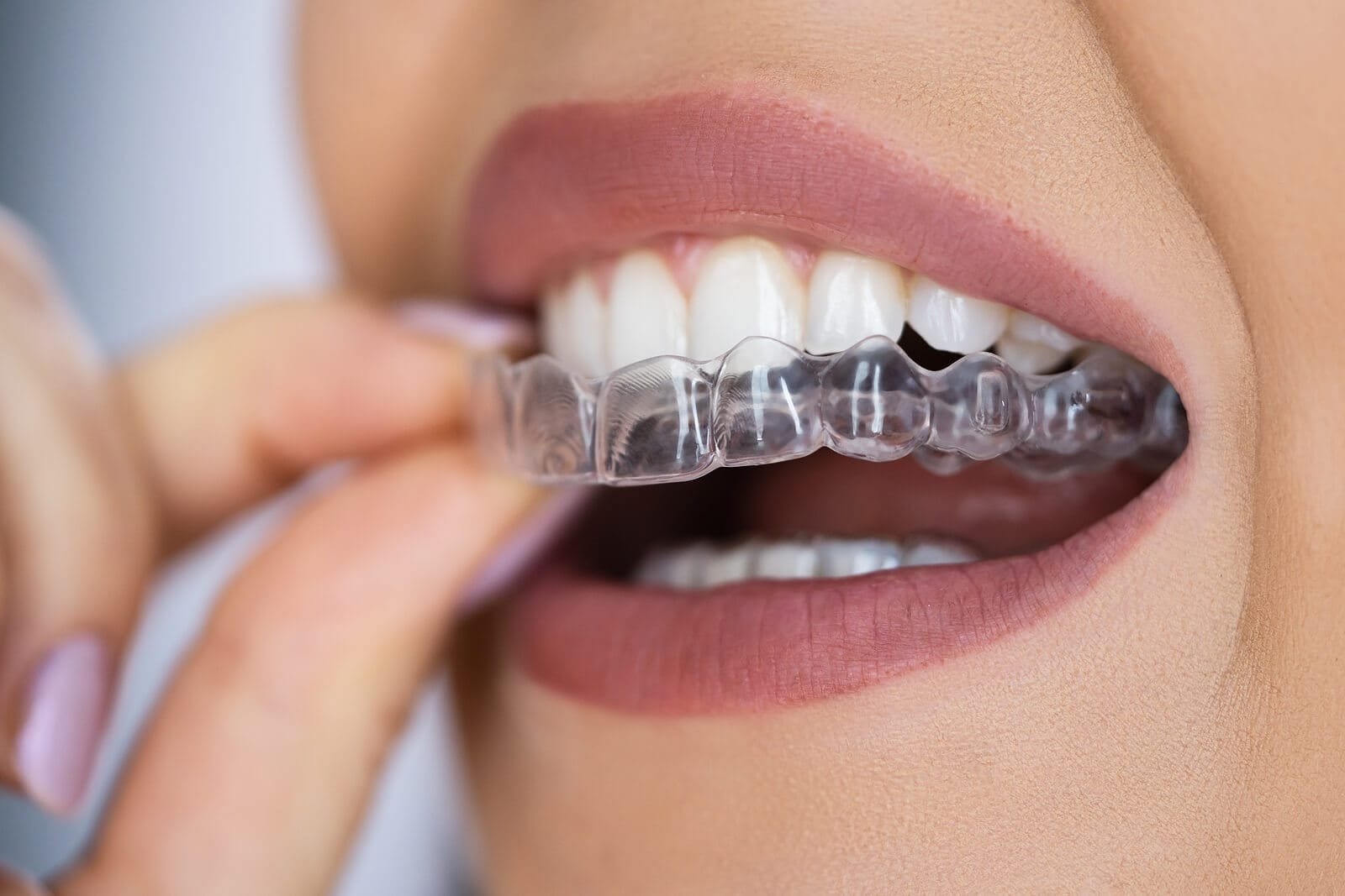 Braces and orthodontic dental treatment