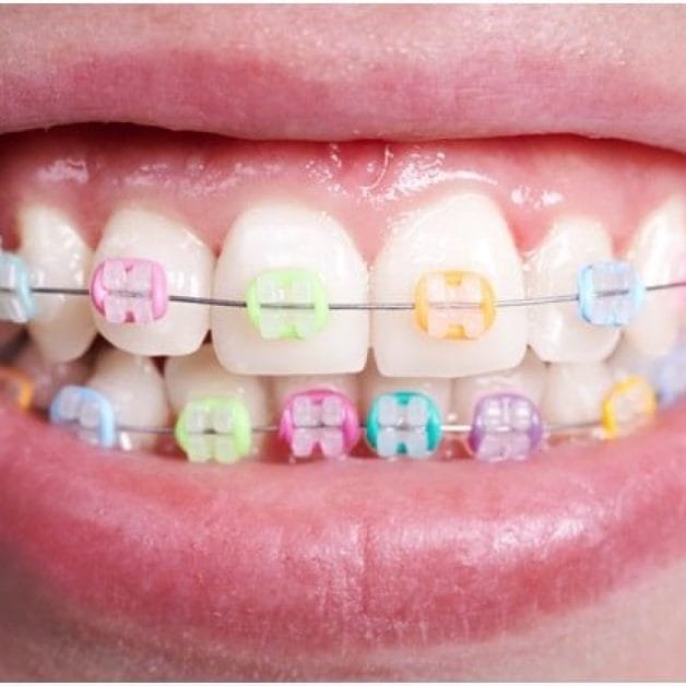 Colourful orthodontic braces treatment