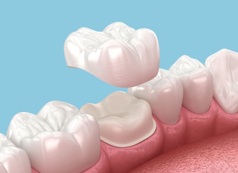 Dental crown and bridge consultation