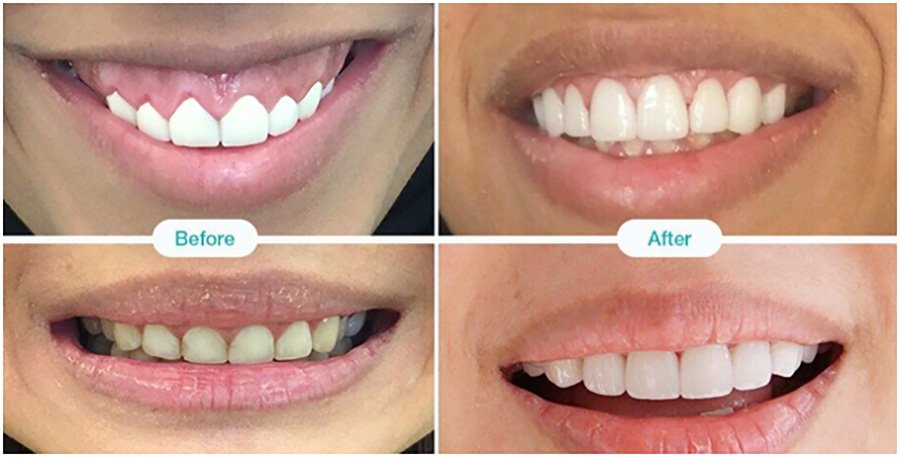 Cosmetic dentistry and smile enhancement