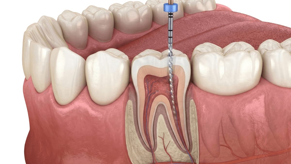 Root canal and endodontic dental treatment