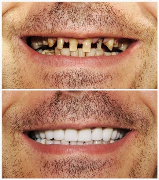 Smile makeover restorative dental treatment