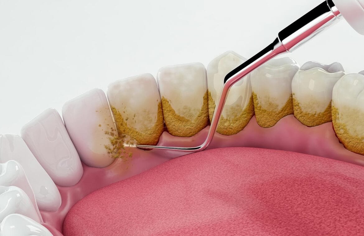 Cleaning and oral-hygiene care for healthier gums