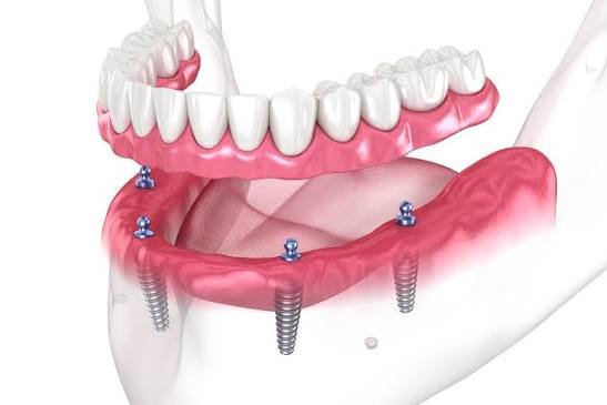 All-on-4 full-arch dental implant rehabilitation