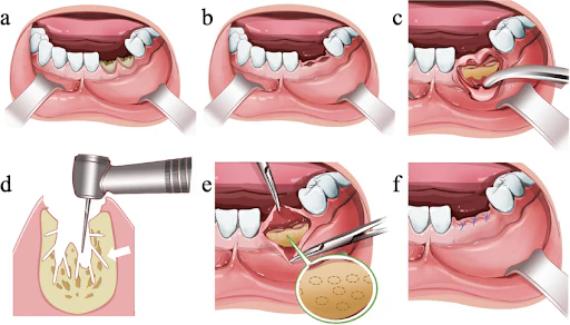 Alveoloplasty jawbone reshaping