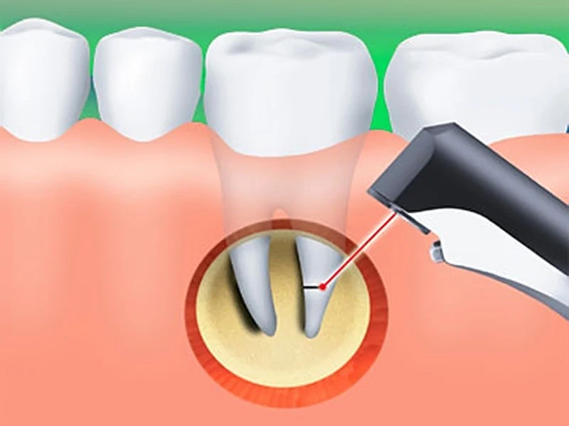 Apicoectomy root-end surgery