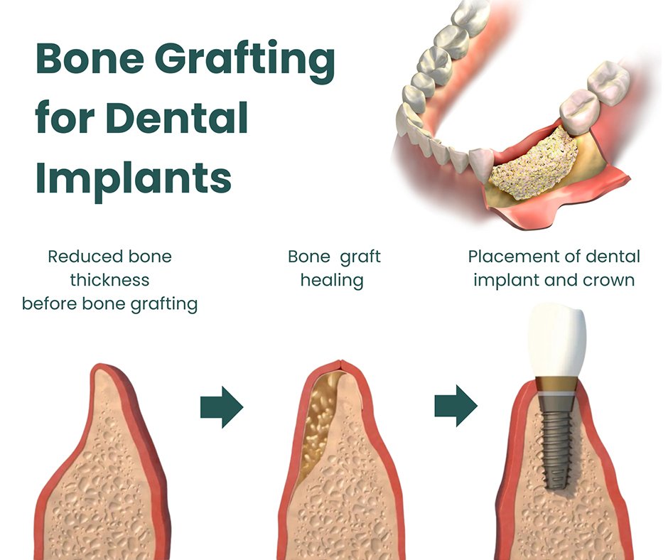 Dental bone grafting and augmentation