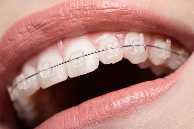 Ceramic braces