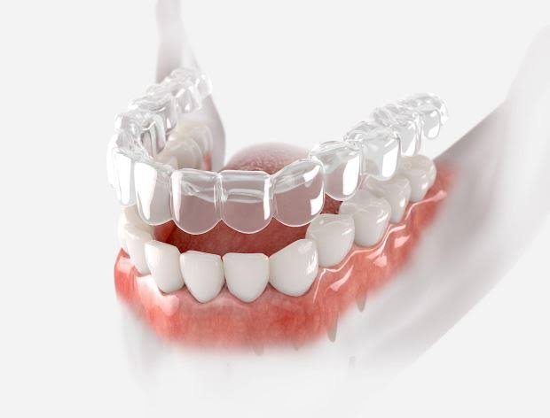 Clear aligners