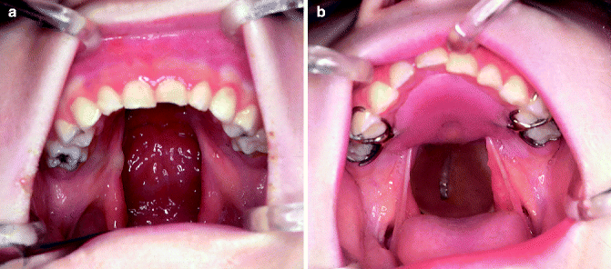 Cleft-related oral appliance for a child
