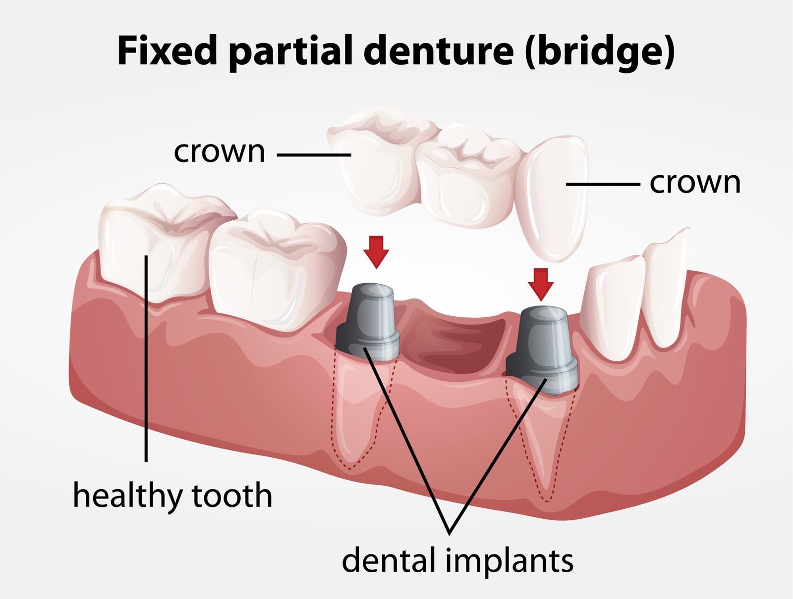 Dental crowns and bridges prosthodontic treatment