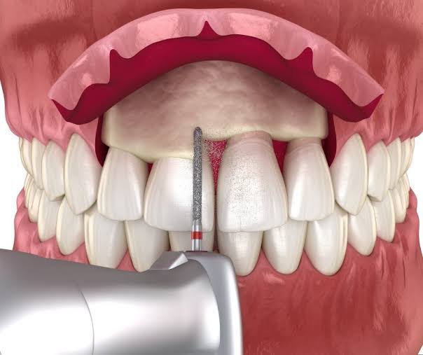Dental crown-lengthening procedure
