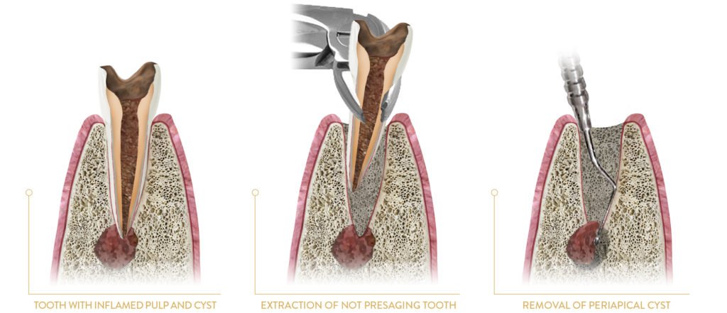 Jaw cyst evaluation and enucleation