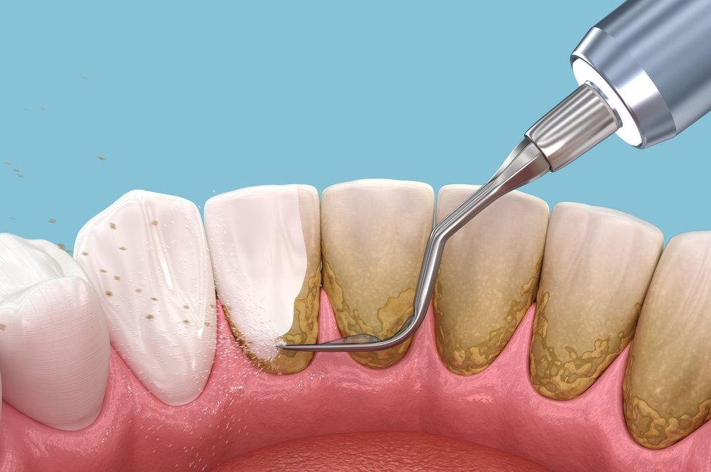 Deep scaling and root planing treatment