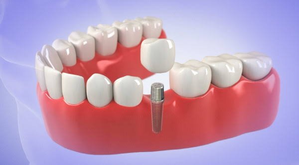 Delayed dental implant placement