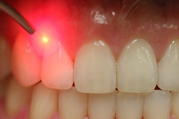 Dental laser desensitisation treatment
