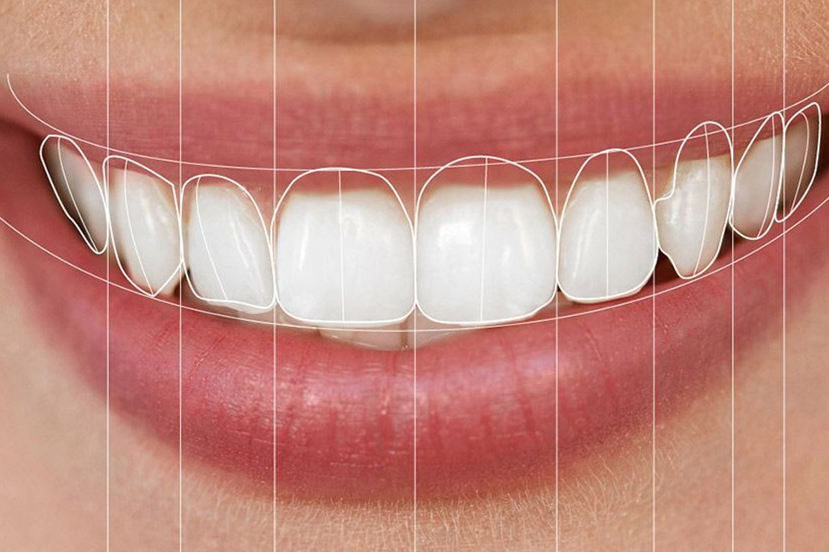 Digital Smile Design and smile planning