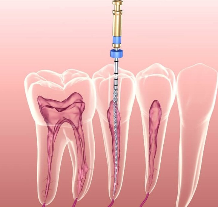 Root canal and endodontic treatment at Pristine Dental Raipur
