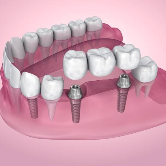 Fixed dental bridge