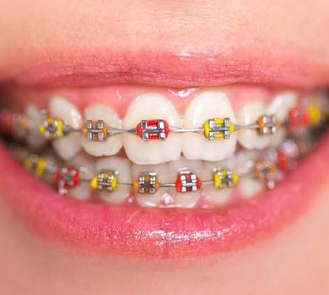 Fixed metal braces