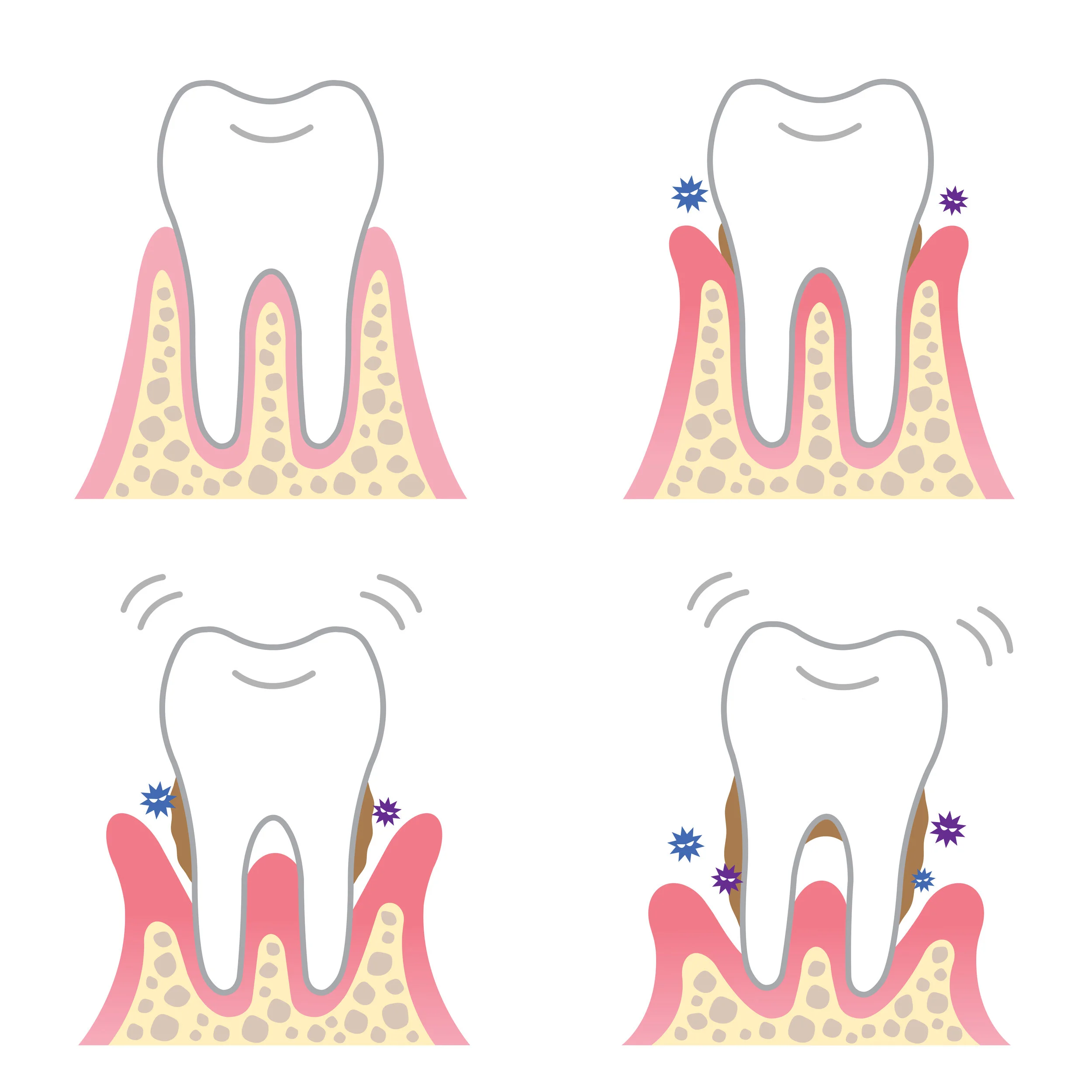 Periodontal flap surgery with grafting