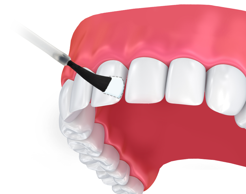 Fluoride application treatment