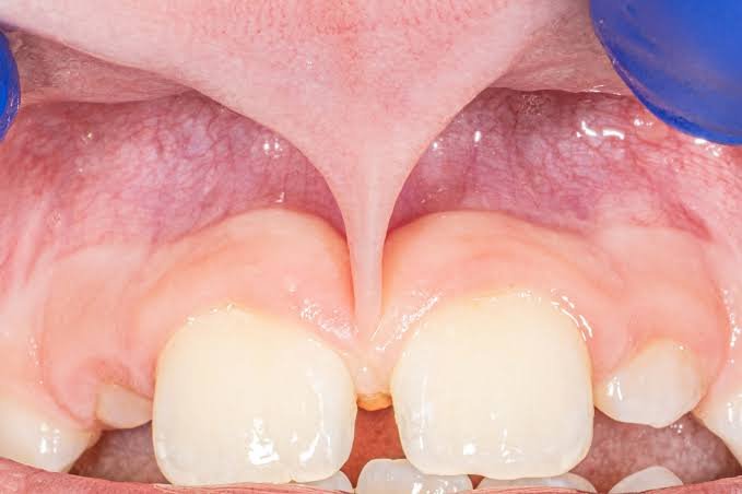 Oral frenectomy procedure