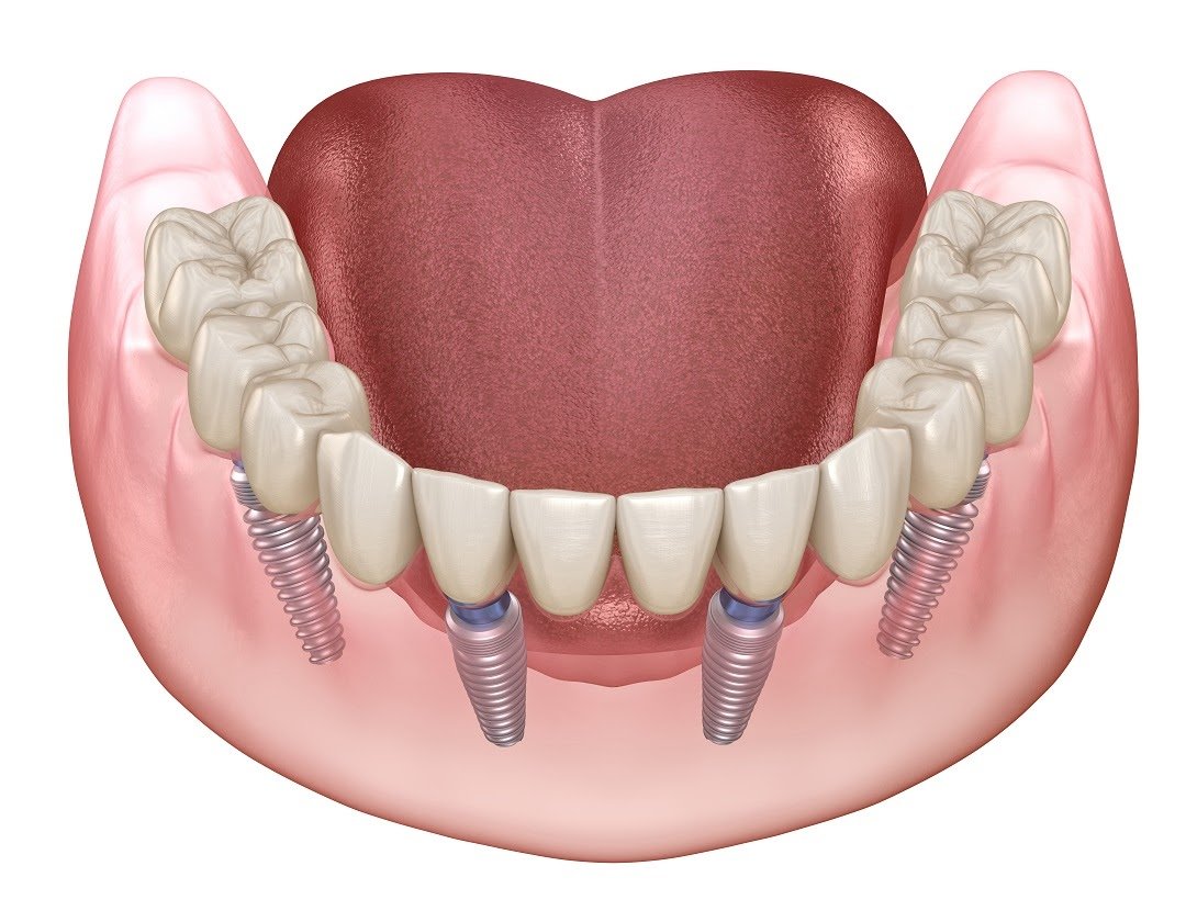 Full-mouth dental rehabilitation