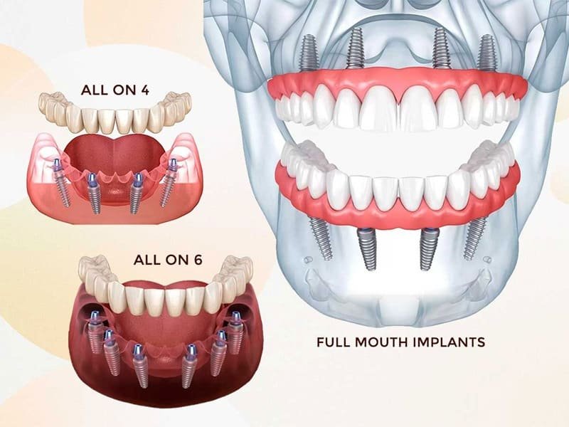 Full-mouth dental rehabilitation