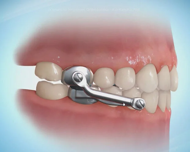 Functional orthodontic appliances