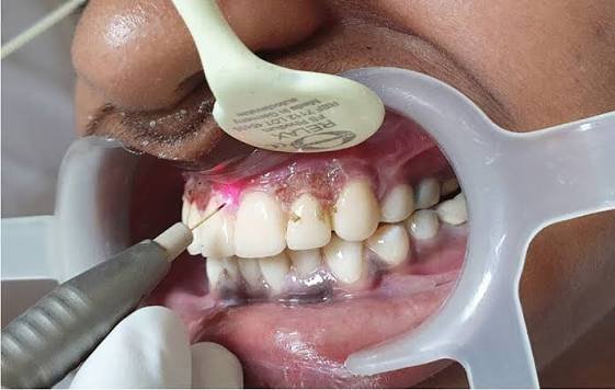 Gingival depigmentation treatment