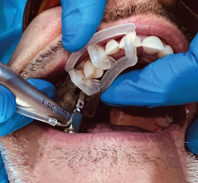 Digitally guided dental implant placement