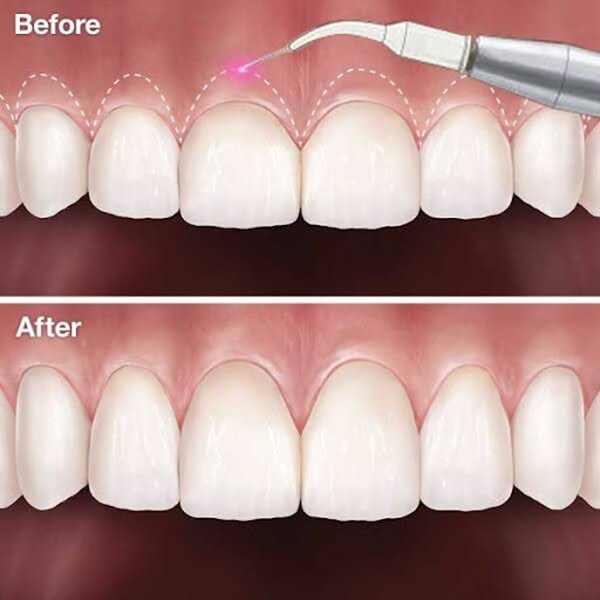 Gum recontouring treatment