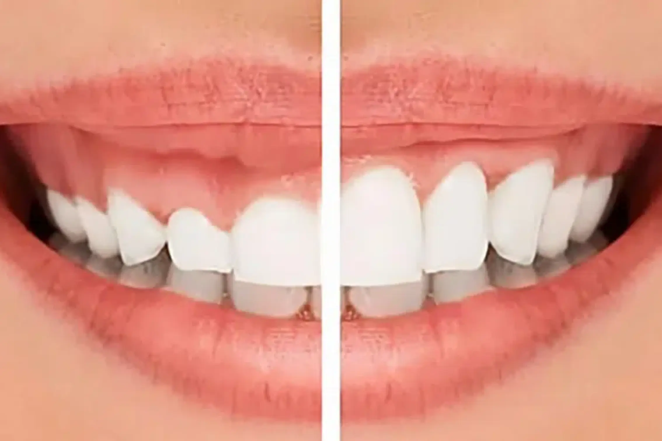 Gummy-smile assessment and correction