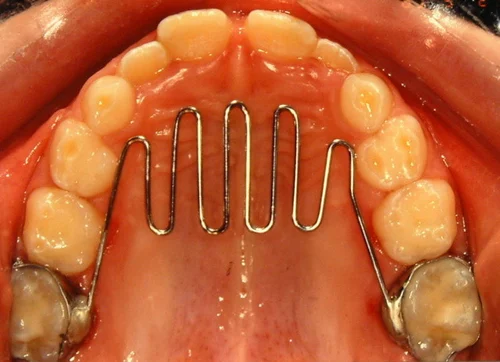 Habit-breaking orthodontic appliance
