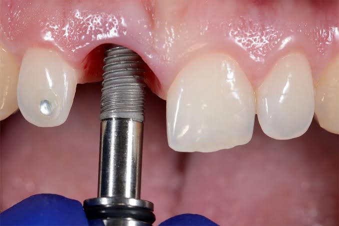 Immediate dental implant placement
