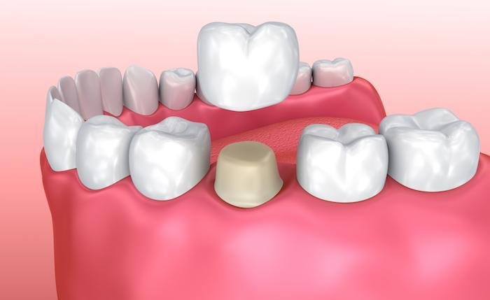 Immediate temporary dental crown
