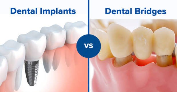 Implant crown and implant-supported bridge