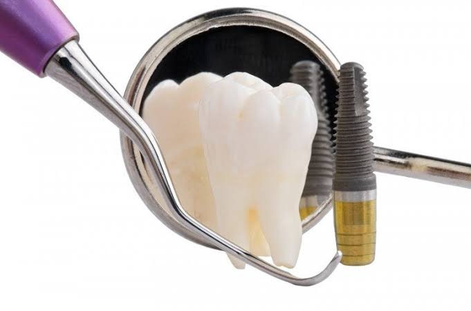 Dental implant maintenance