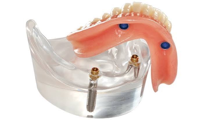 Implant overdenture treatment at Pristine Dental Raipur