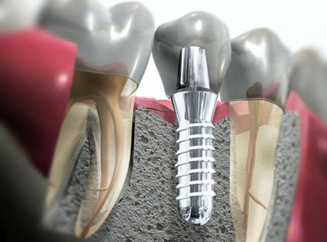 Dental implant treatment and implantology