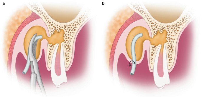 Incision and drainage of dental infection