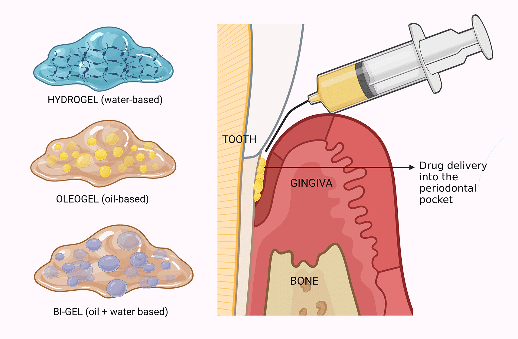 Local drug delivery for periodontal pockets