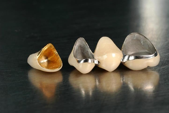 Metal-ceramic dental crown