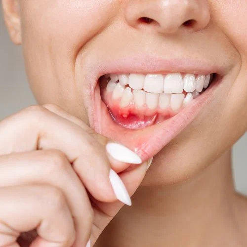 Professional evaluation and treatment of oral ulcer