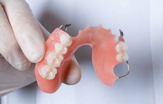Partial denture treatment at Pristine Dental Raipur