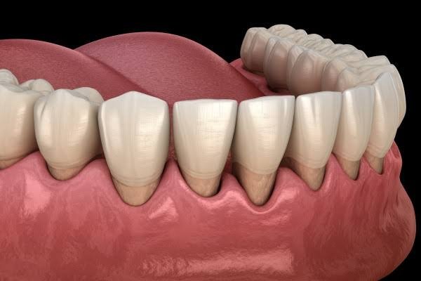 Periodontal and gum treatment at Pristine Dental Raipur