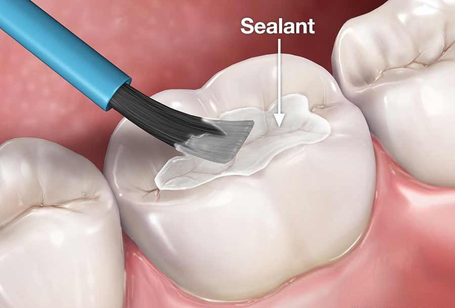 Pit and fissure sealants treatment