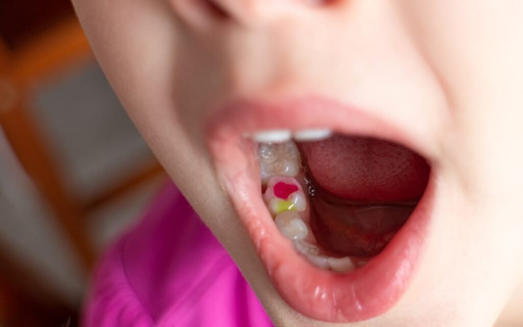 Primary tooth filling for a child