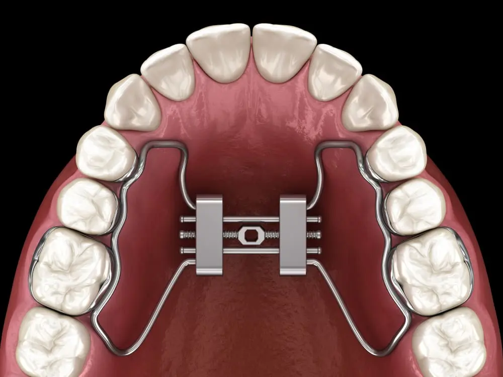 Rapid maxillary expansion appliance